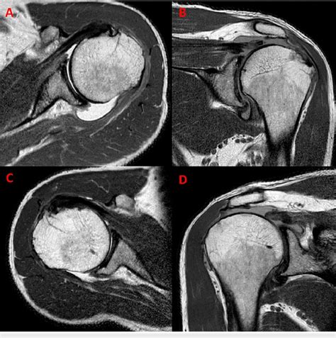 special tests for rotator cuff tear vs mri|shoulder mri rotator cuff tear.